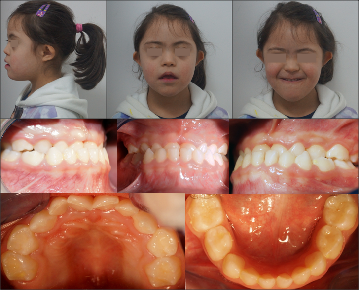 Oral Health in Down Syndrome IntechOpen