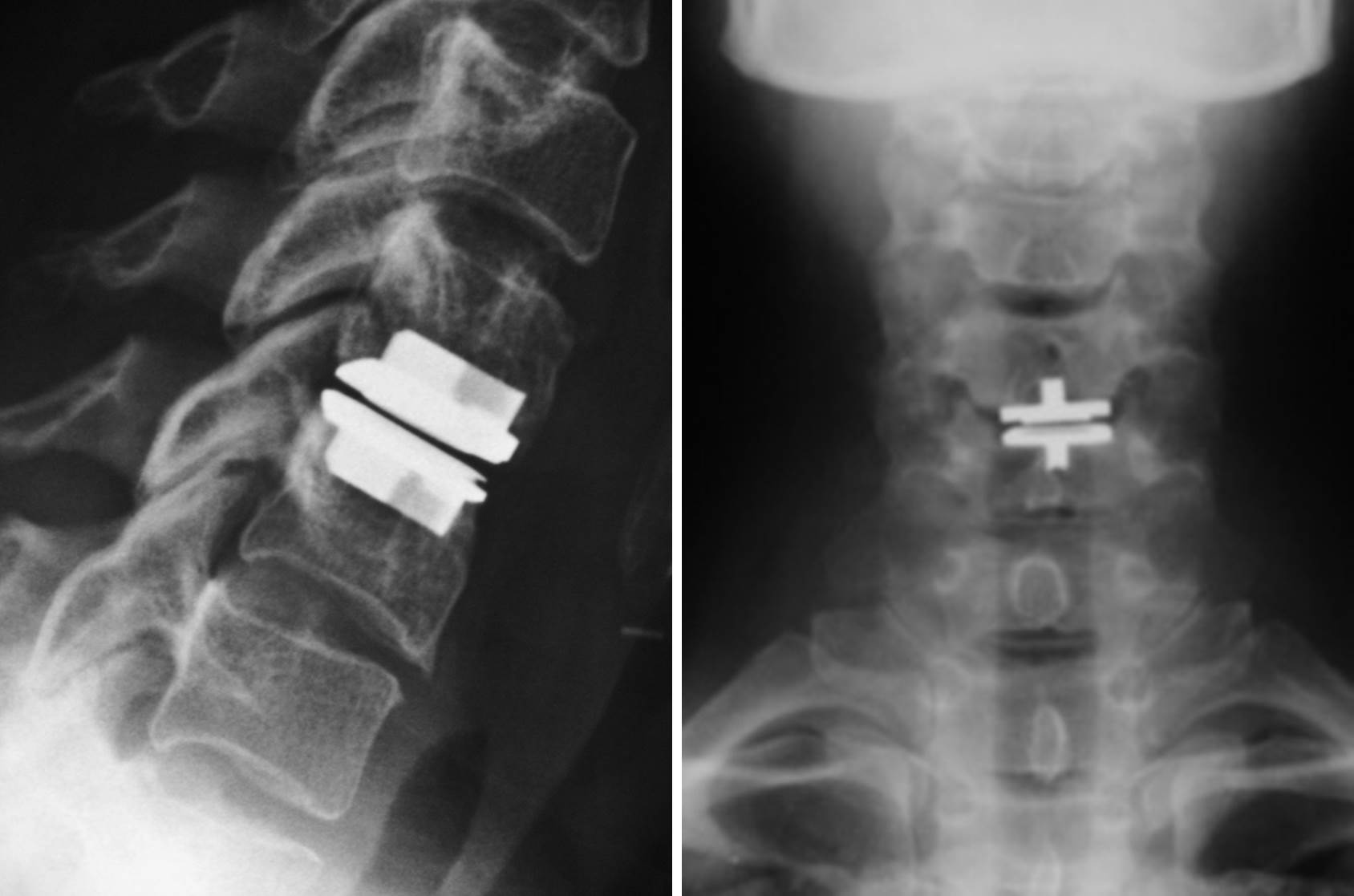 Cervical Disc Arthroplasty — A Clinical Review IntechOpen