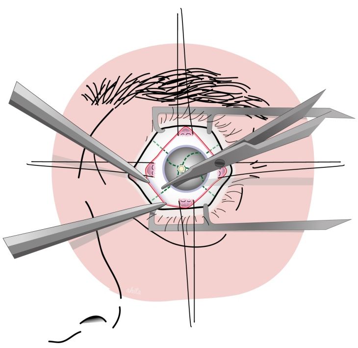 Eye Removal — Current Indications and Technical Tips IntechOpen