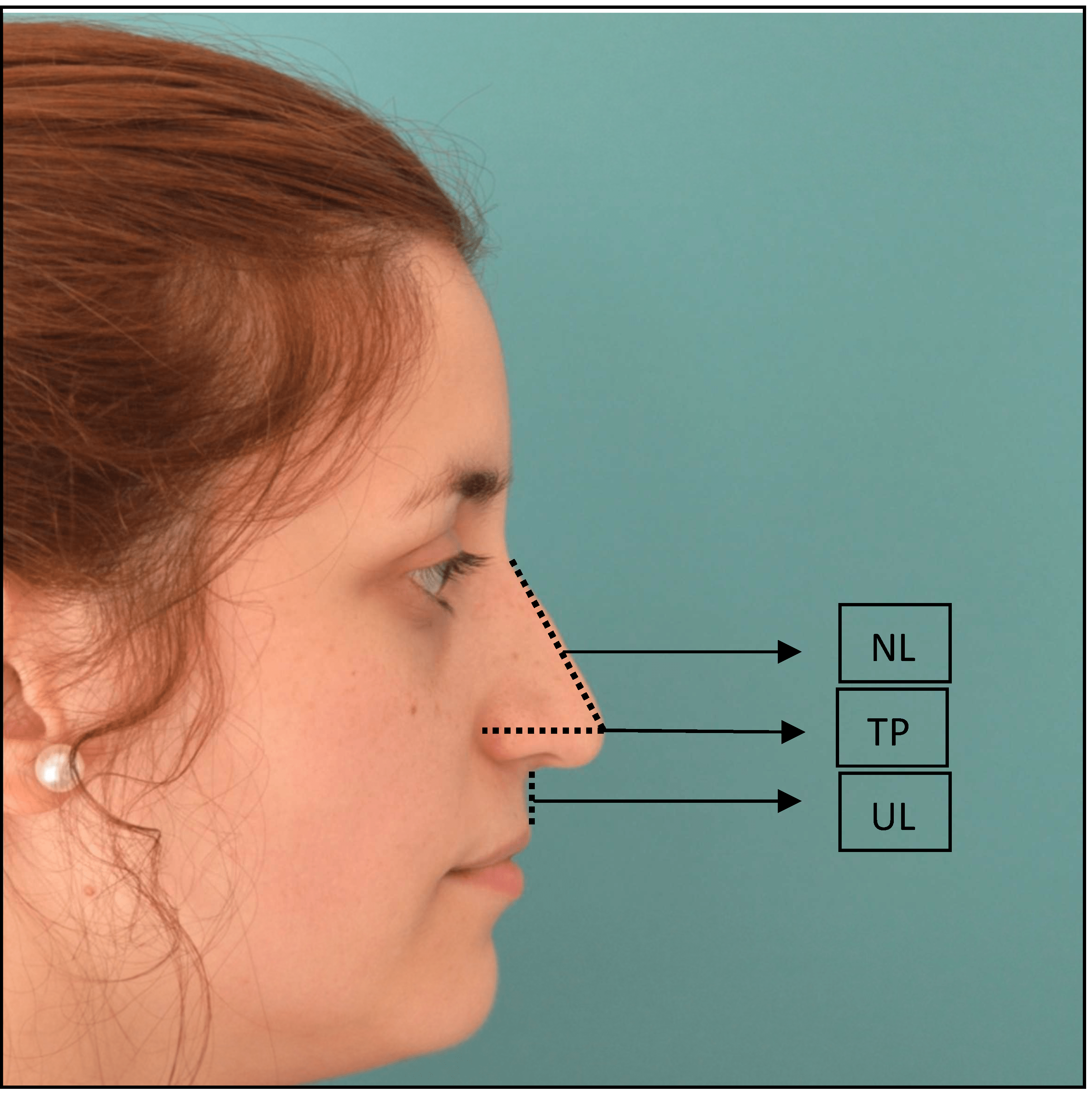 Depressor Septi Nasi Muscle Resection or Nerve Block IntechOpen