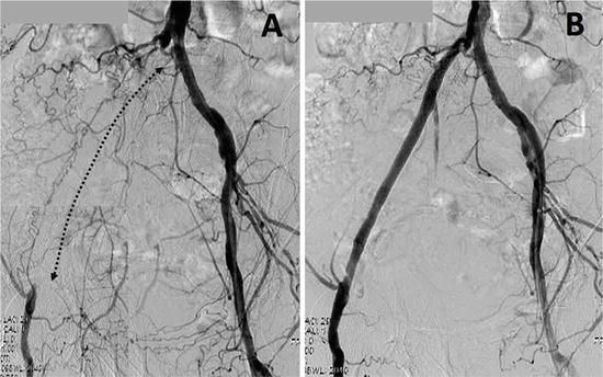 Basics Of Angiography For Peripheral Artery Disease | Intechopen
