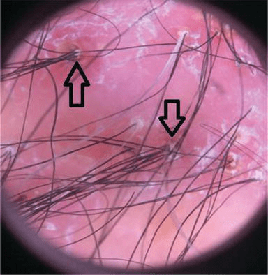 Infections, Infestations And Neoplasms Of The Scalp | Intechopen