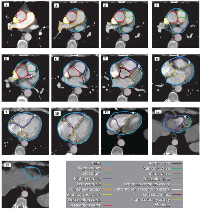 RadiationRelated Heart Disease UptoDate Developments IntechOpen