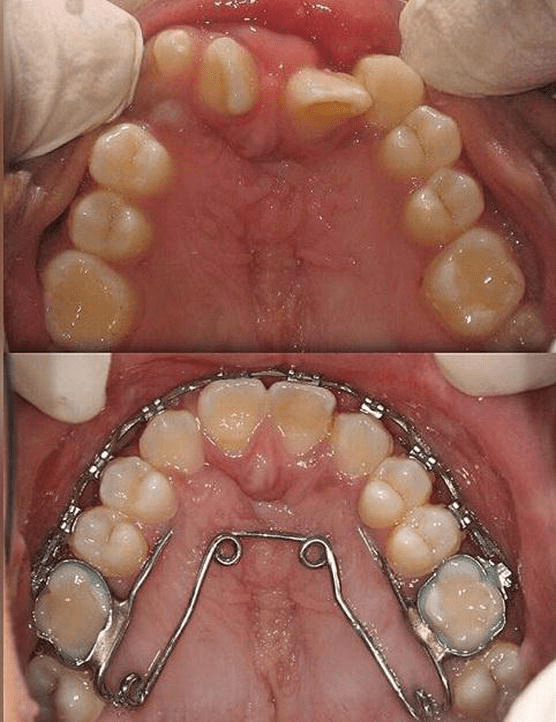 Cleft Lip and Palate Management from Birth to Adulthood An Overview