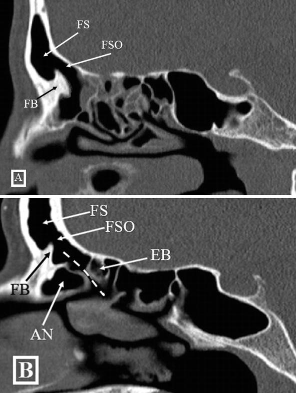 Paranasal Sinus Anatomy What the Surgeon Needs to Know IntechOpen