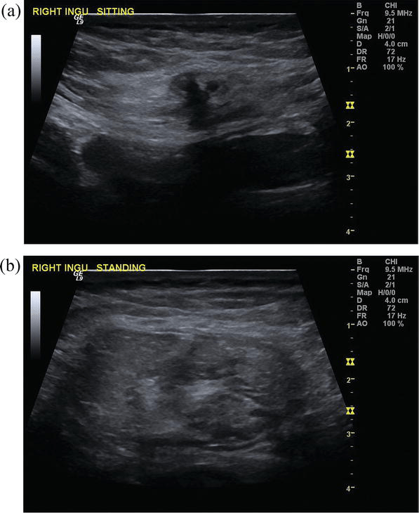 Ventral Hernia Ultrasound