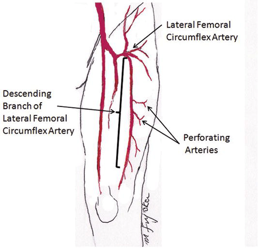 Application of Free Flow‐Through Anterolateral Thigh Flap for the Reconstruction of an Extremity
