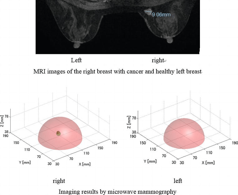 Microwave Imaging for Early Breast Cancer Detection IntechOpen