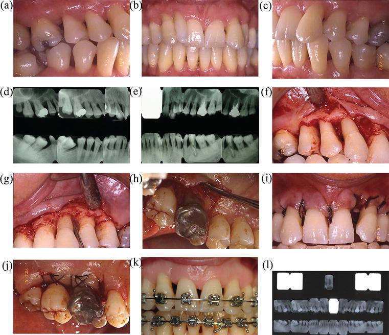 Periodontal Considerations in Adult Orthodontic Patients IntechOpen