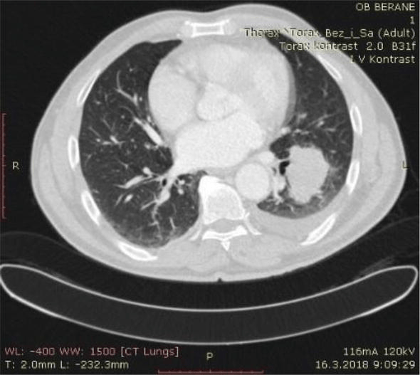 Pleural Effusions in Lung Cancer Detection and Treatment IntechOpen