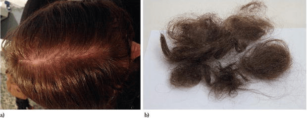 It is often believed that men inherit baldness from their mother's. Web there are two distinct types of hair problems experienced by women with polycystic ovary syndrome (pcos): Seema Purvis
