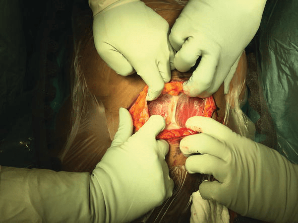 The Surgical Technique Of Caesarean Section: What Is Evidence Based? | Intechopen