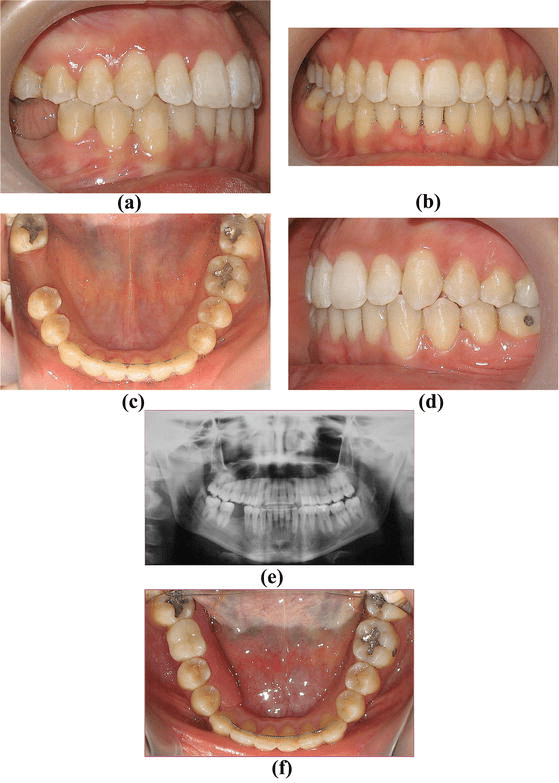 How Long Does It Take For Teeth To Shift After Not Wearing.
