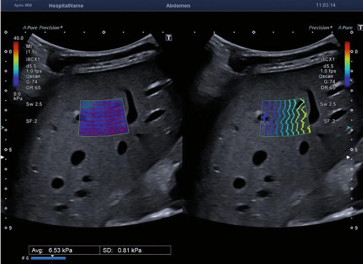 2D Shear Wave Elastography for Liver Fibrosis Evaluation IntechOpen