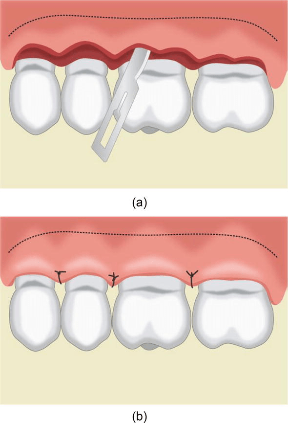 Flap Techniques in Dentoalveolar Surgery IntechOpen
