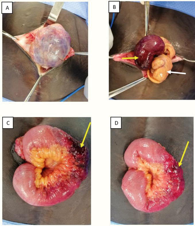 Umbilical Hernias in Adults Epidemiology, Diagnosis and Treatment