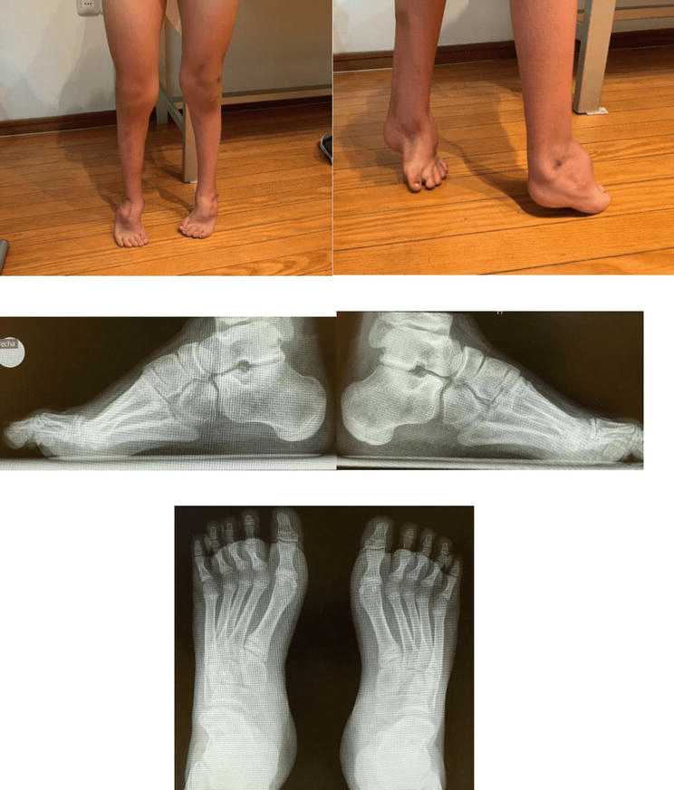 Orthopedic Approach to Spina Bifida IntechOpen