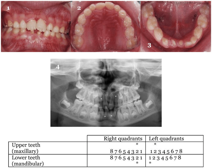 Failure of Tooth Development Prevalence, Causes and Clinical