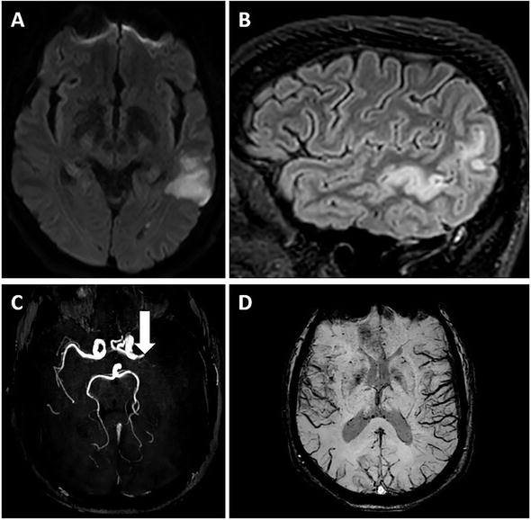 Imaging of Vascular Aphasia IntechOpen