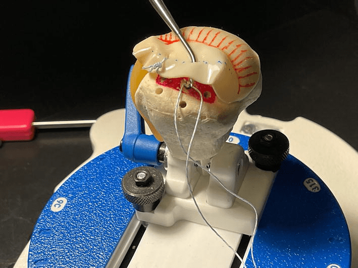 SingleRow Rotator Cuff Repair IntechOpen