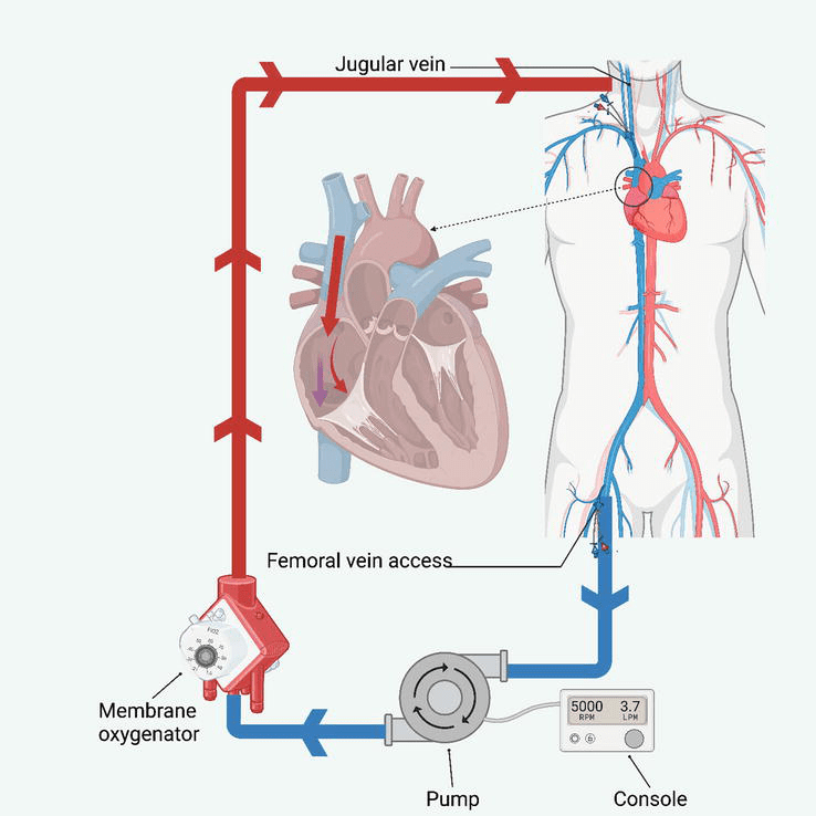 VVECMO in Respiratory Insufficiency IntechOpen