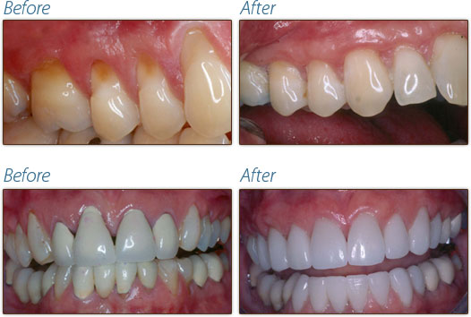 Healing Dental Implant Surgery with PRP Intelligent Dental