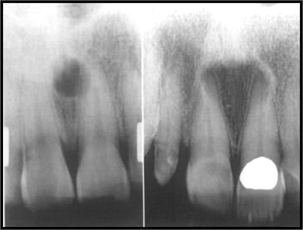 Radiographic Appearance of Cysts Part 3 and Scintigraphy Intelligent