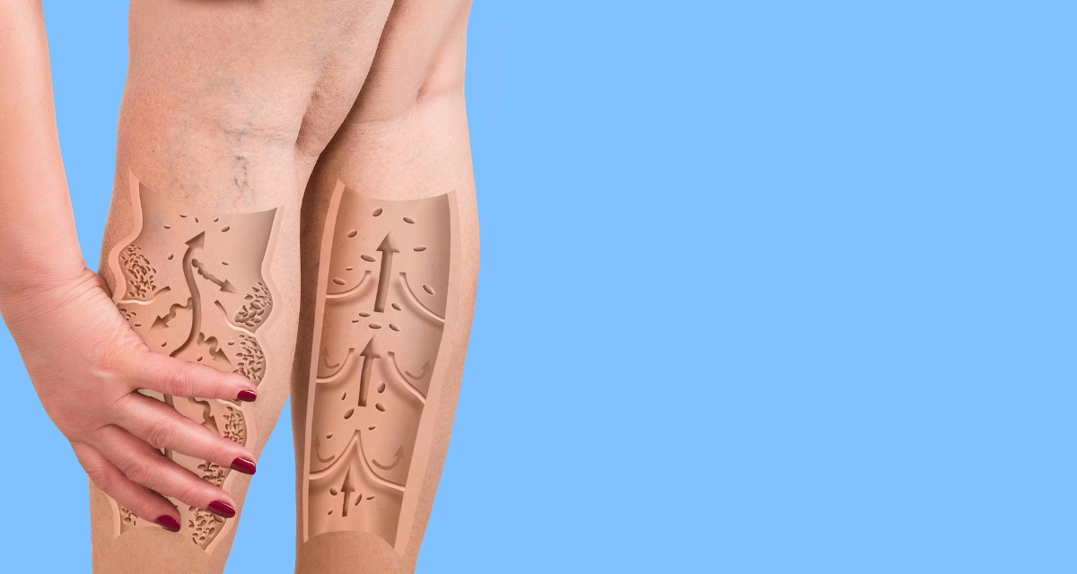 Swollen Legs in the Elderly, What Helps? Interweave Healthcare