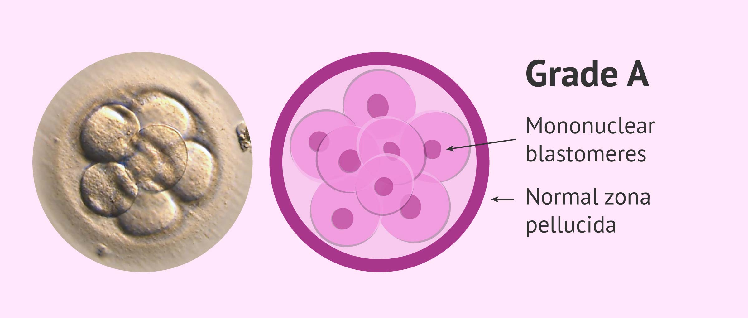 Embryo Quality & Grading Does It Affect IVF Success?