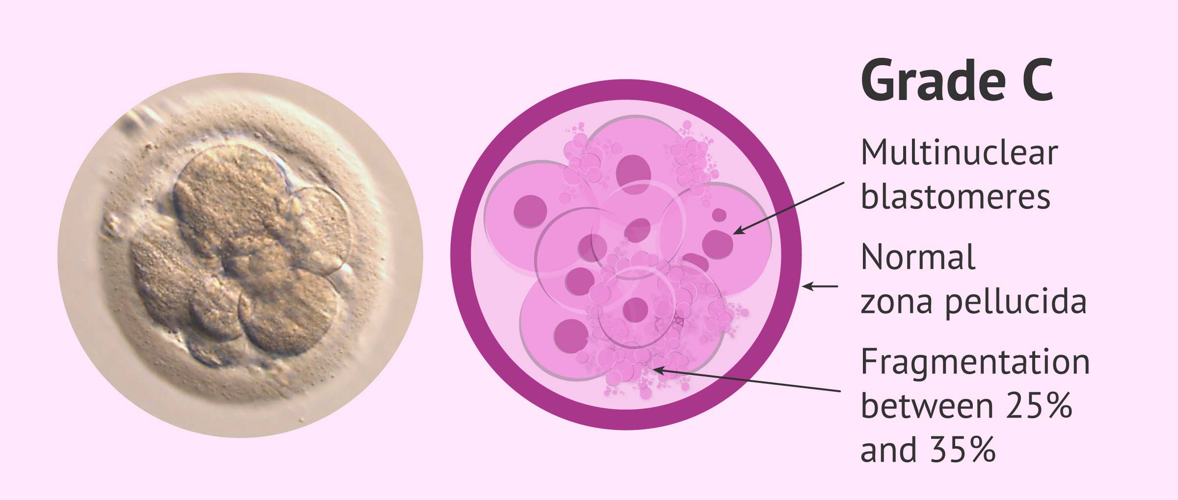 Embryo Quality & Grading Does It Affect IVF Success?