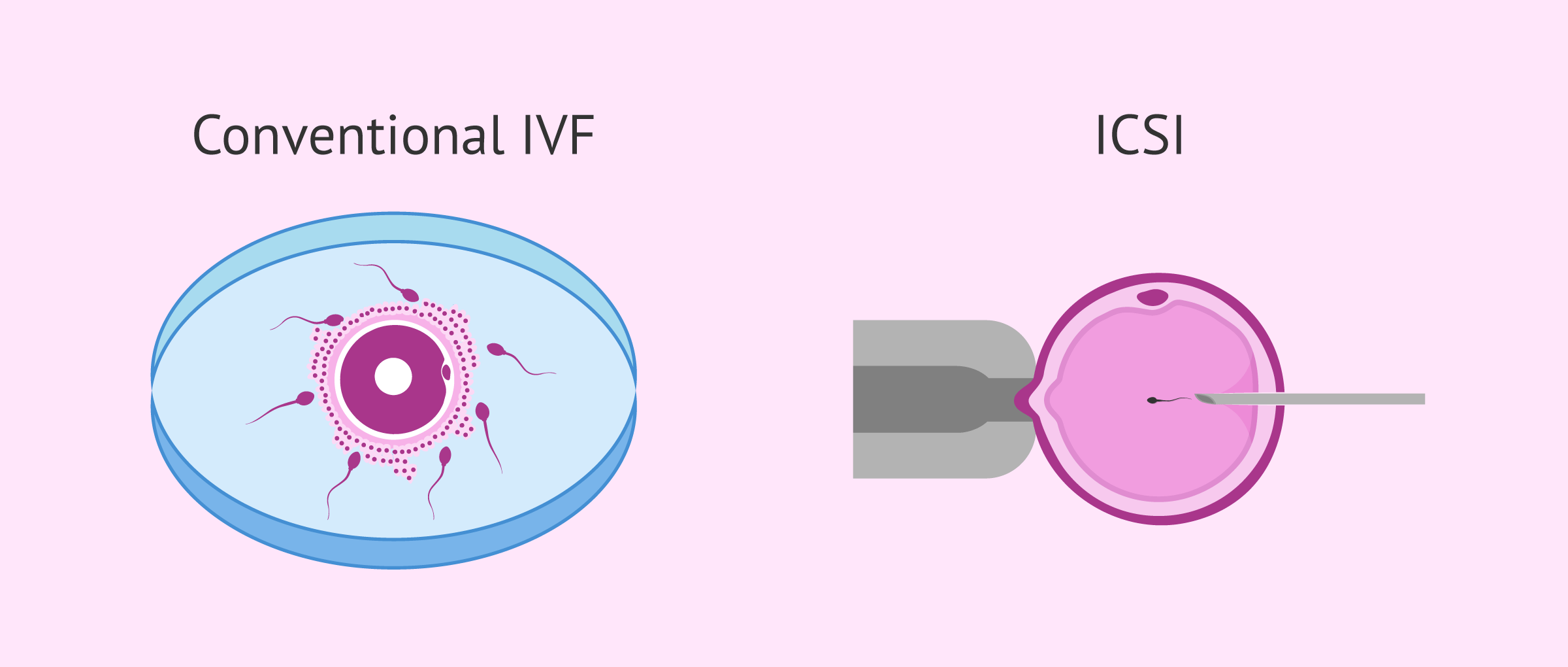 In Vitro Fertilization Process