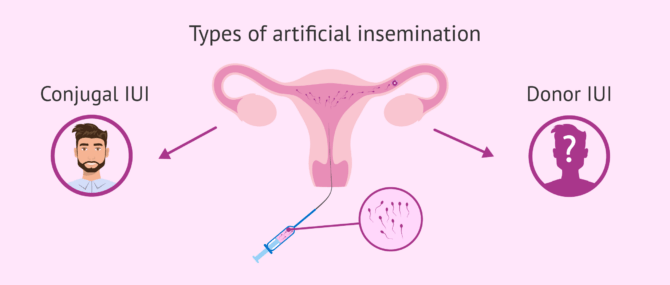 What Is Artificial Insemination with Husband’s Sperm (AIH)?