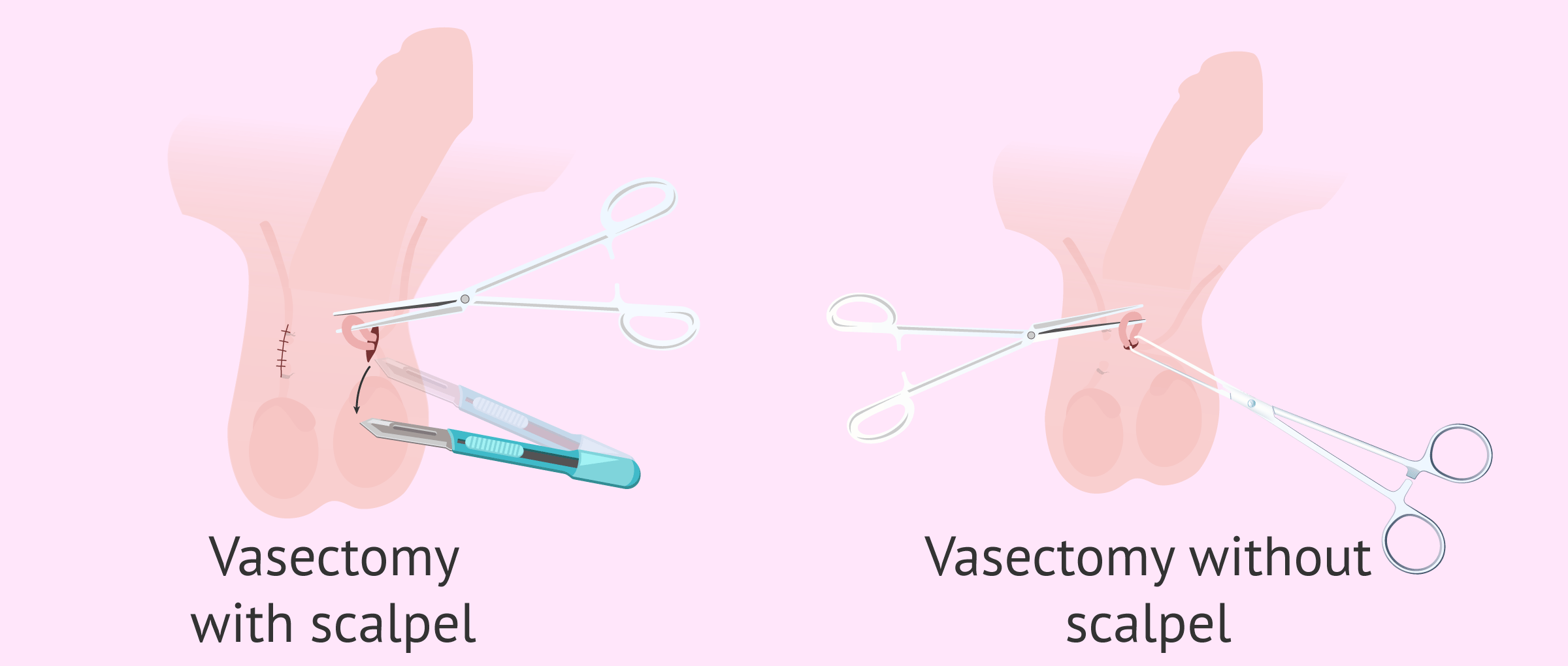 Post Vasectomy Semen Analysis How Many Tests to Confirm Sterility?