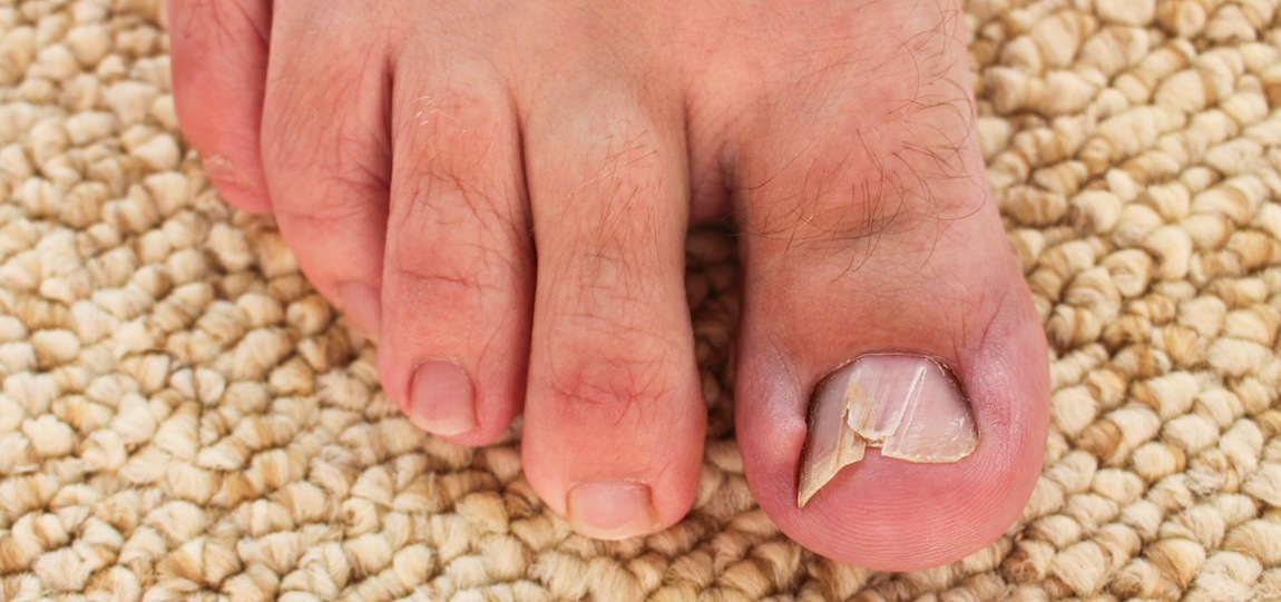 Toenail Problems Ipswich Podiatry Centre