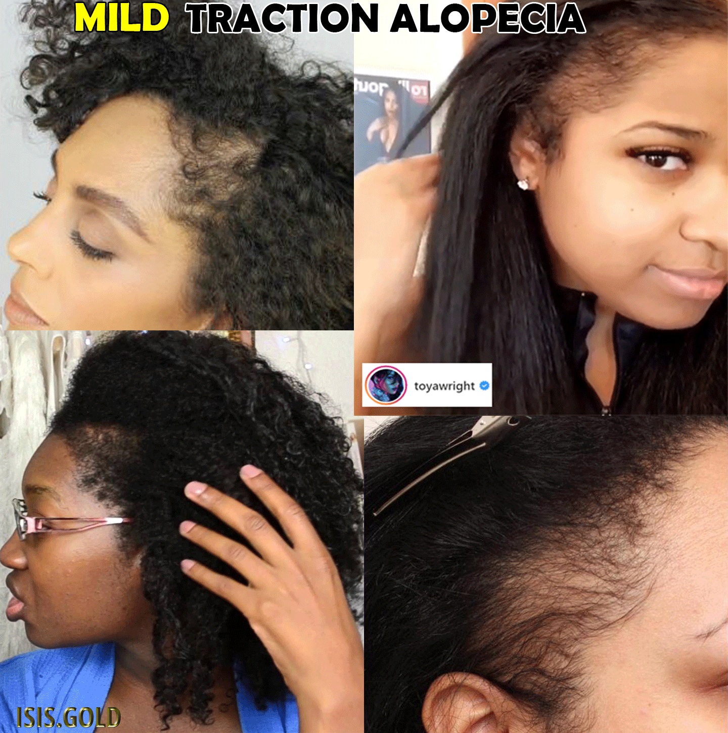 TRACTION ALOPECIA HOW TO GROW EDGES BACK FAST! » Best TRACTION ALOPECIA HOW TO GROW EDGES BACK FAST! » Best
