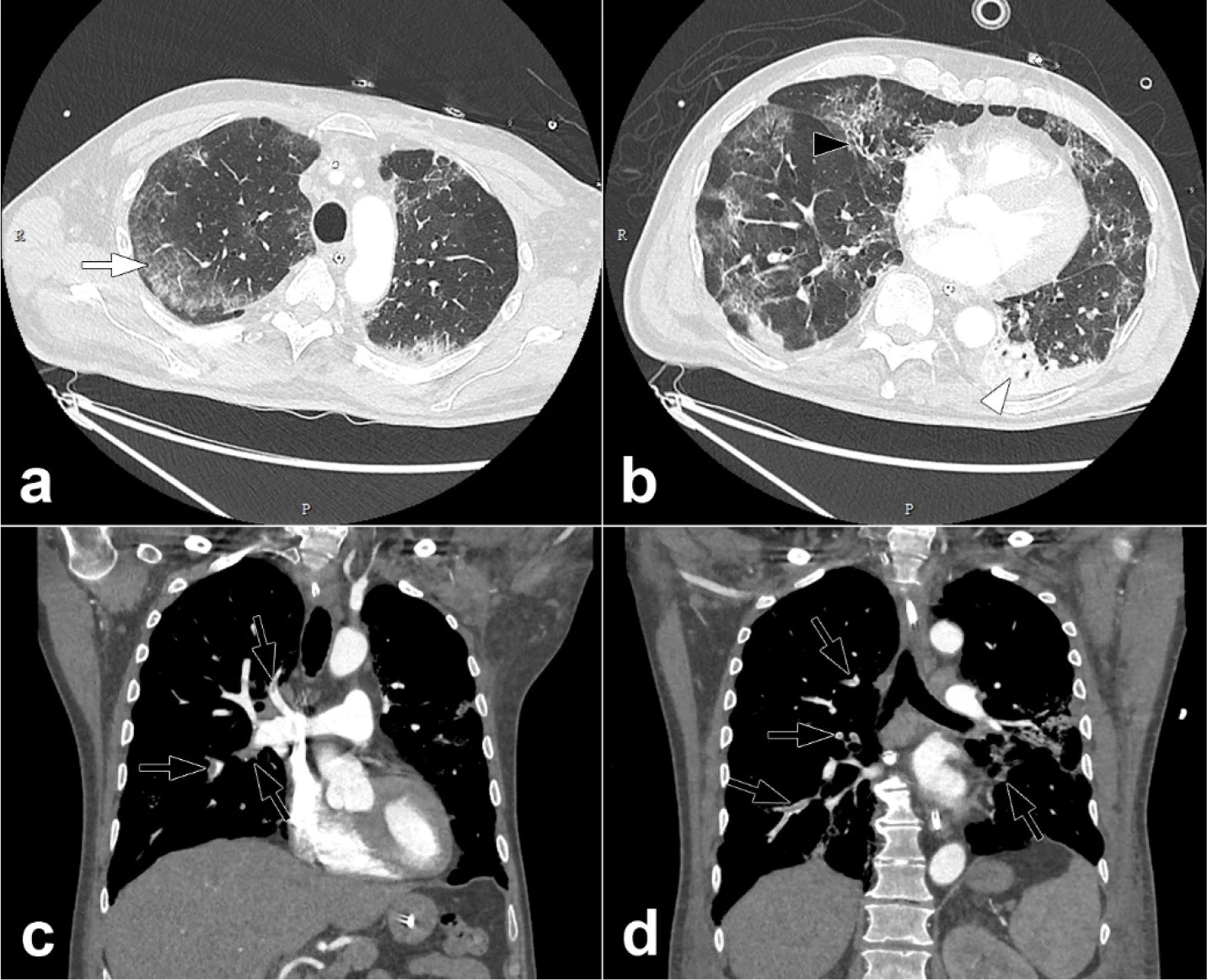 New Research Highlights Blood Clot Dangers Of Covid-19 | Imaging Technology News