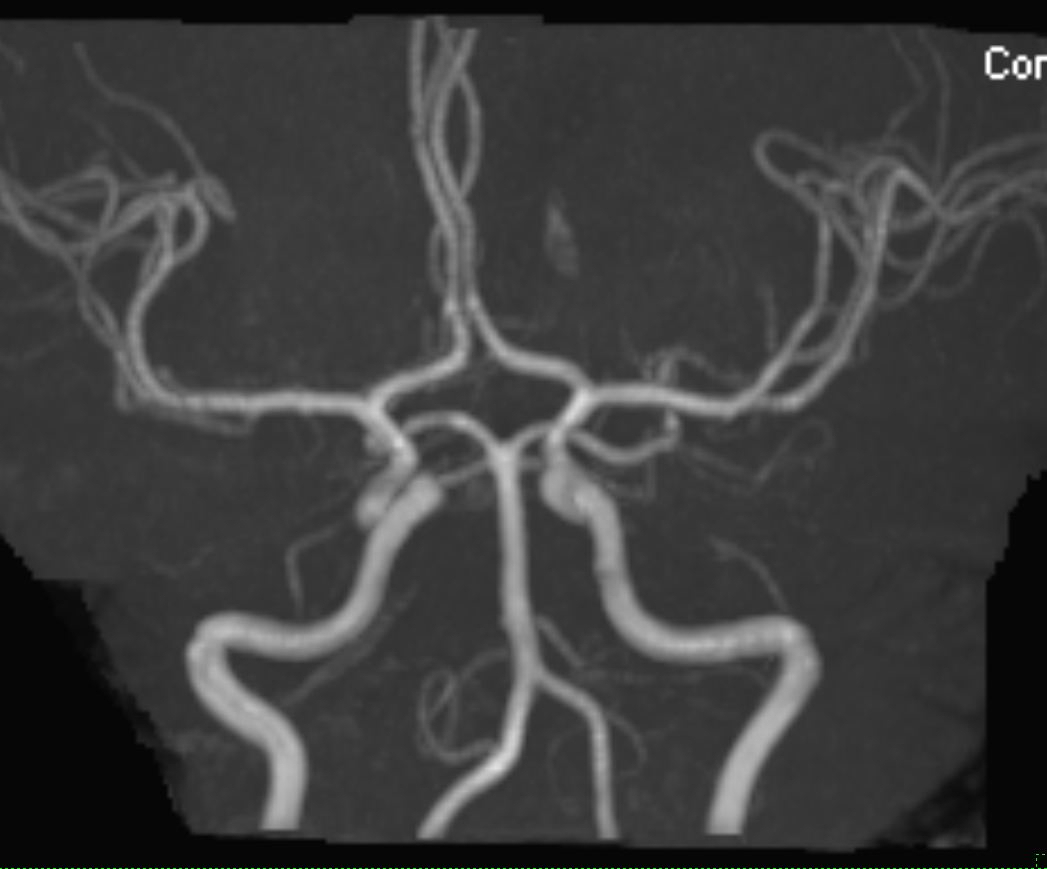 Fda Approves Gadavist As First Mr Angiography Contrast Agent For Supra-Aortic Arteries | Imaging Technology News