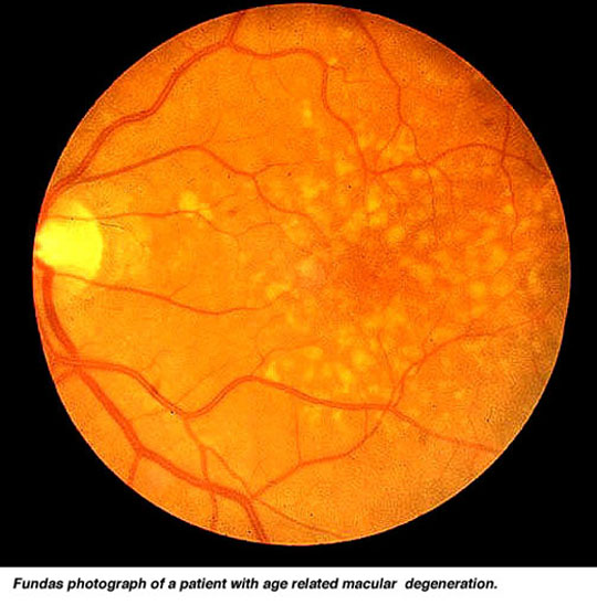 Retinal pathologies