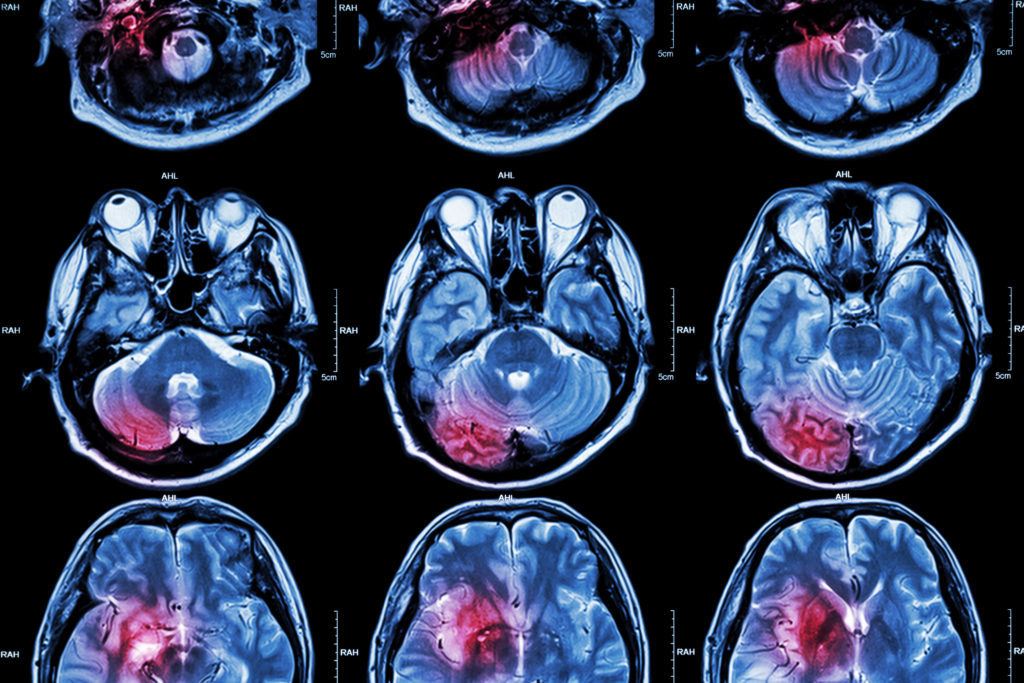 Primary Brain Tumor Types, What to Know, and FAQs