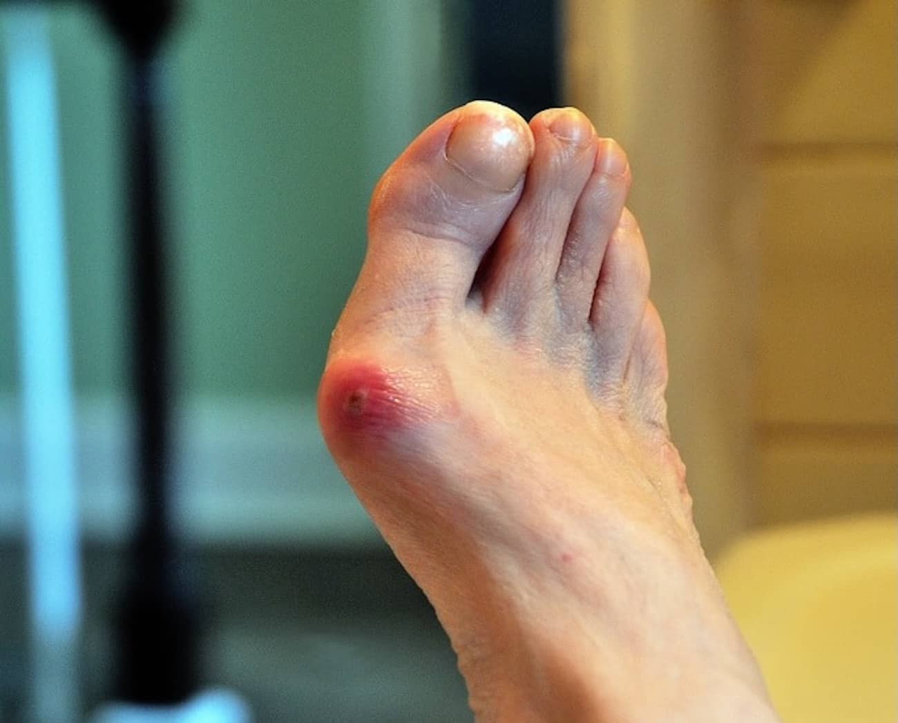 5 Simple NonSurgical Ways to Alleviate Bunion Pain