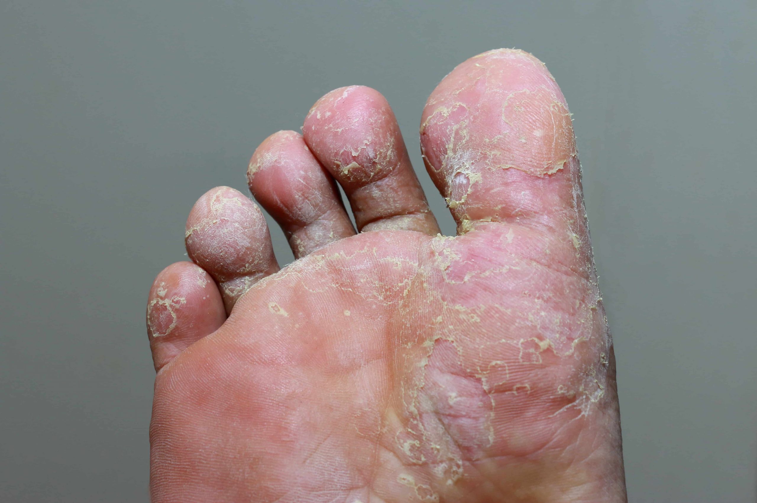 Types of Fungal Foot Infections JAWS podiatry