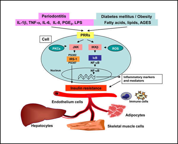 Impact of Periodontitis on the DiabetesRelated