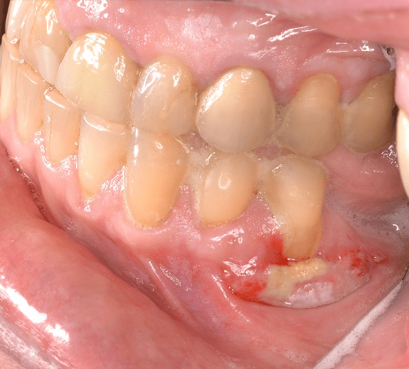 Managing Patients with Gingival Graft Failure or Loss jcda