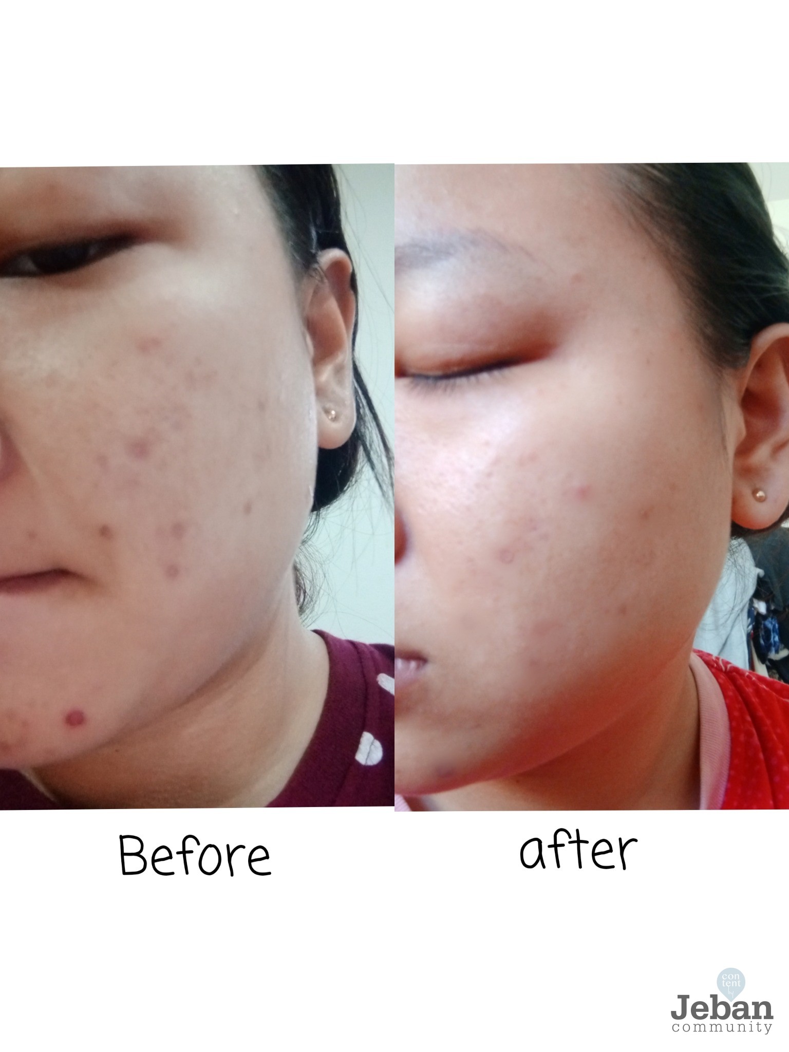 TEA TERR OIL ผลิตภัณฑ์ของ HERB MINISTRY สิวยุบได้ภายใน3วัน