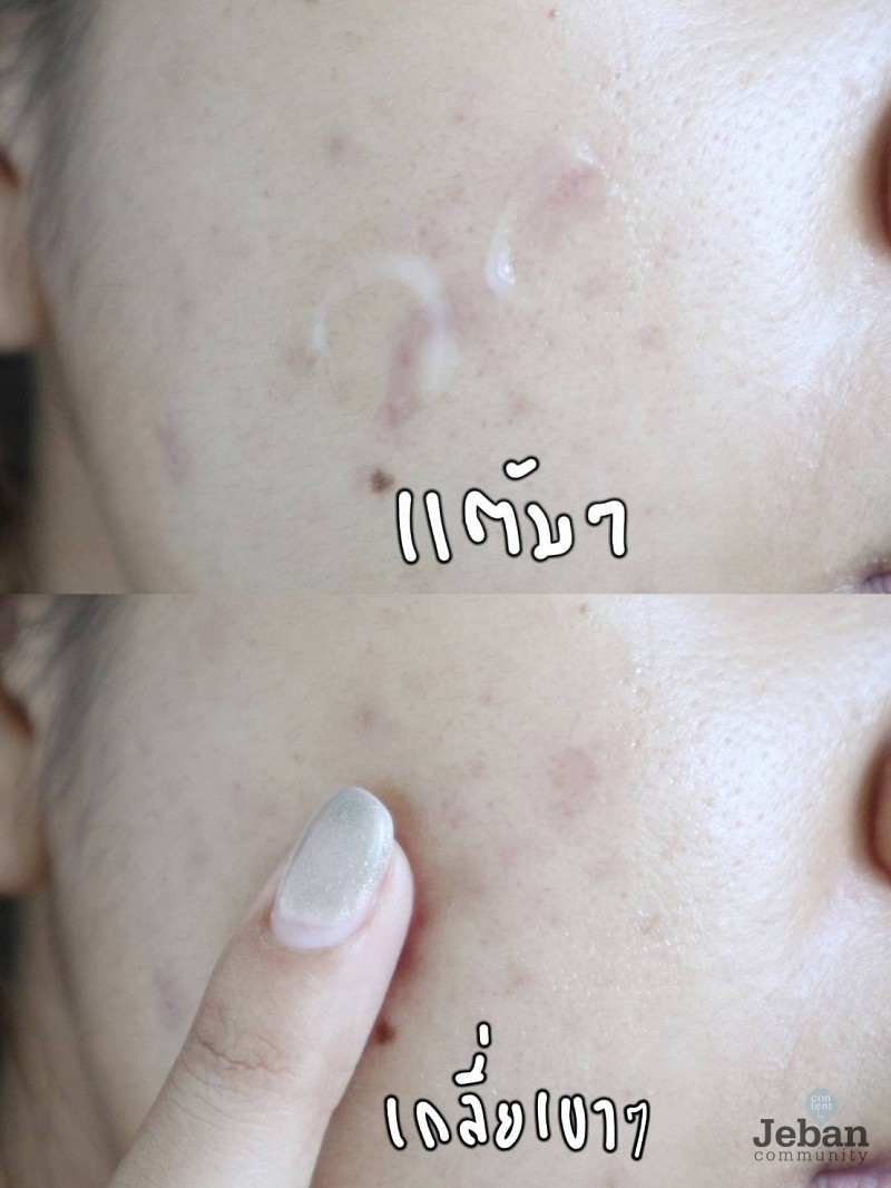 บีเคเเอคเน่ เจลเเต้มสิว 5 วันยุบ!!!