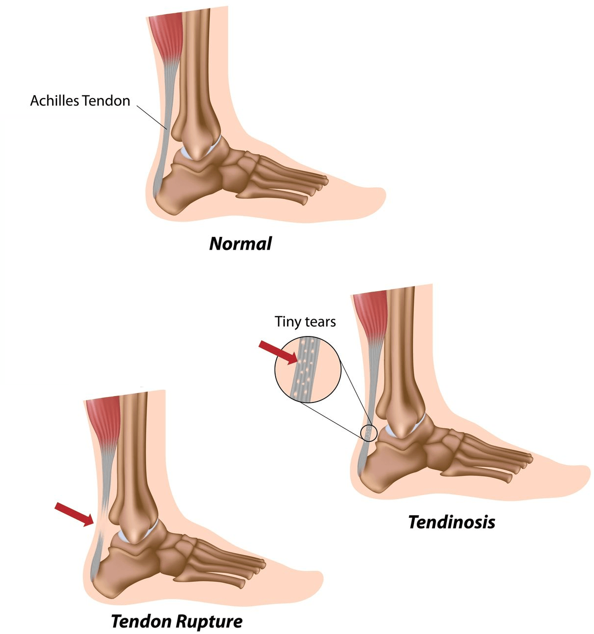 Achilles Tendon Rupture (Video) Jeffrey H. Berg, M.D.