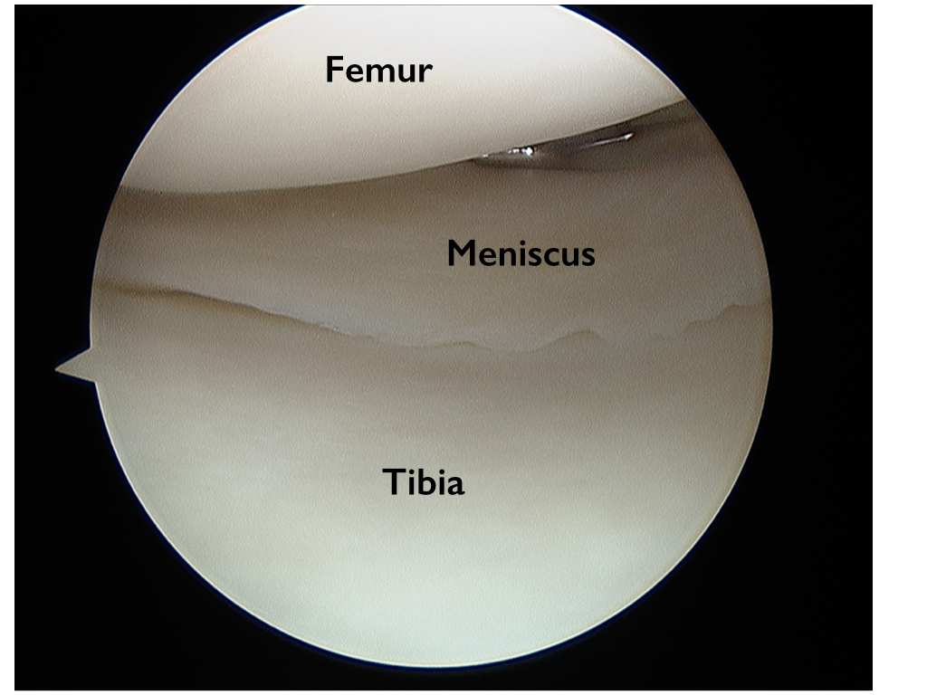 Torn Meniscus Anatomy and Causes (Video) Jeffrey H