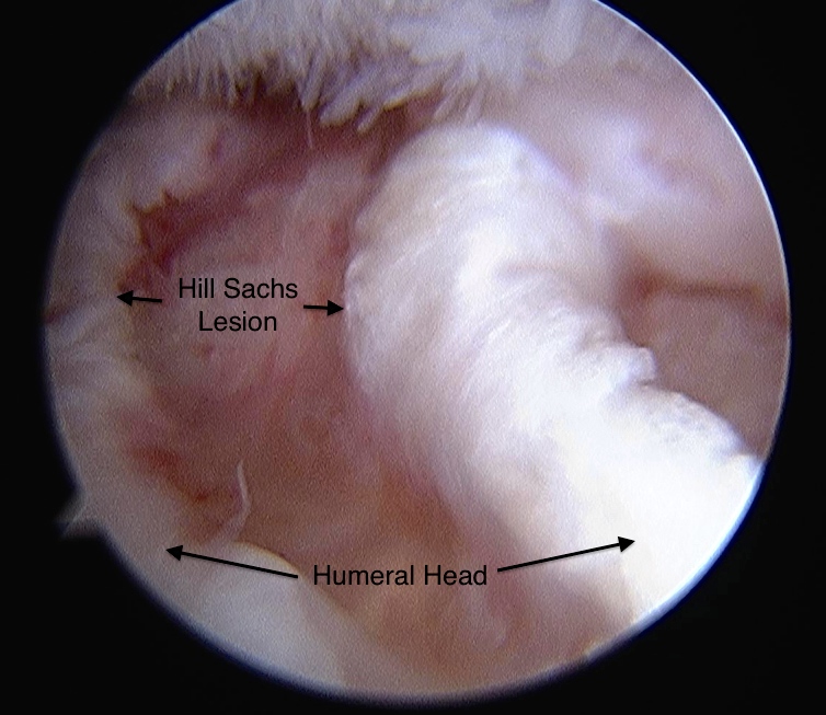 Bankart Lesion Definition, Anatomy & Causes Jeffrey H. Berg, M.D.