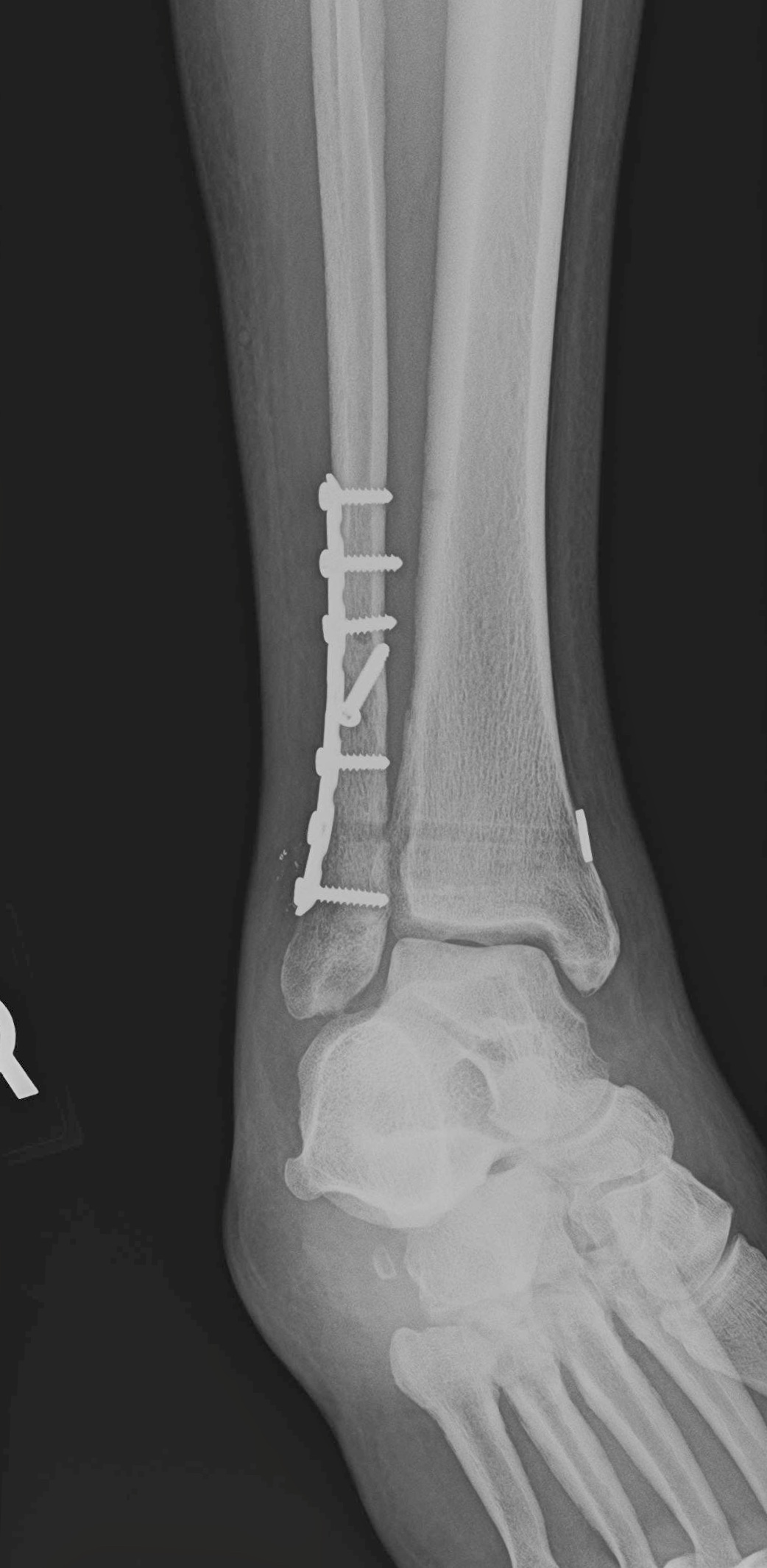 What Ankle Fracture Treatment Is Right For You? Town Center Orthopaedics