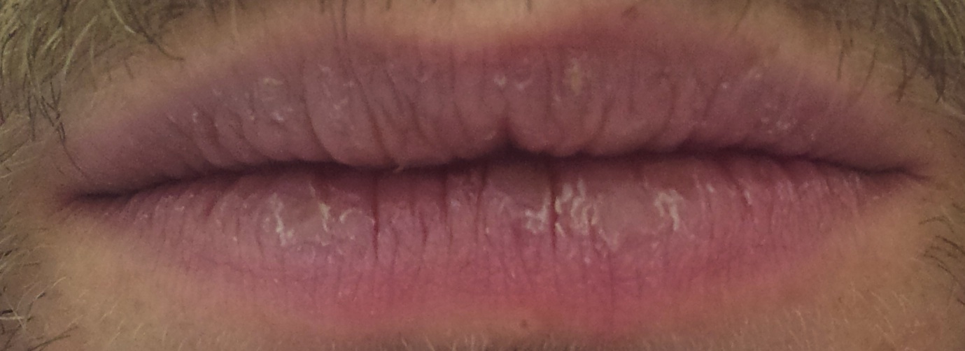 Does Chapstick Work?